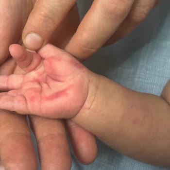 3 Aylık Bebeğimin Acilde Morarması: Güven Sarsıcı Müdahale