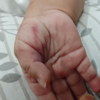 3 Aylık Bebeğimin Acilde Morarması: Güven Sarsıcı Müdahale