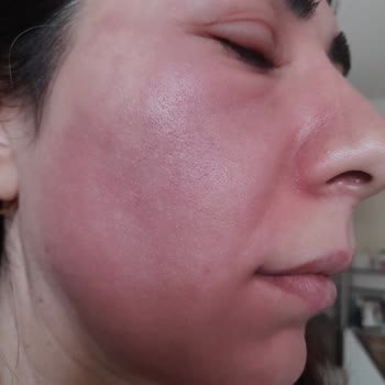 C Vitamini Serumu Sonrası Ciddi Yanma Ve Şişlik Yaşadım