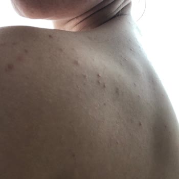 Kullandığım Şampuan Cildimde Ciddi Sorunlara Yol Açtı