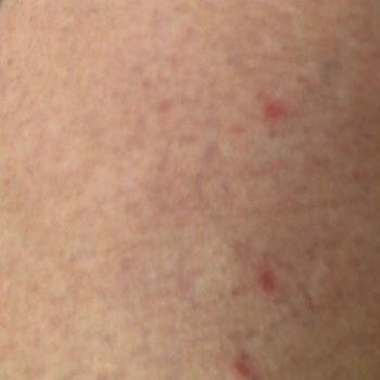 Kullandığım Şampuan Cildimde Ciddi Sorunlara Yol Açtı