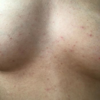 Kullandığım Şampuan Cildimde Ciddi Sorunlara Yol Açtı