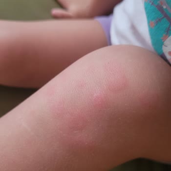 Torku Miniki Çilekli Süt Sonrası Alerjik Reaksiyon Ve Endişe