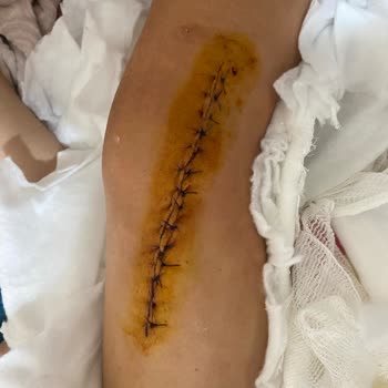 Likya Travel Paragliding Yamaç Paraşütü Pistinde Gerçekleşen Kazayla İlgilenmedi