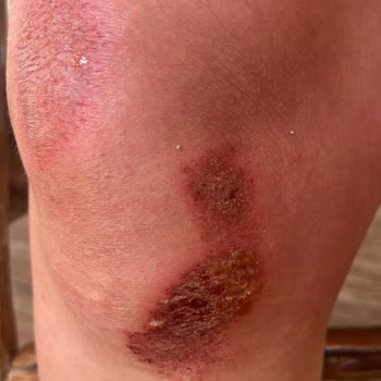 Likya Travel Paragliding Yamaç Paraşütü Pistinde Gerçekleşen Kazayla İlgilenmedi