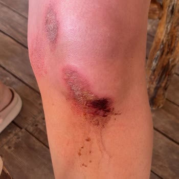 Likya Travel Paragliding Yamaç Paraşütü Pistinde Gerçekleşen Kazayla İlgilenmedi