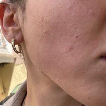 Bobbi Brown Vitamin Enriched Face Base Caused Severe Breakouts After Purchase