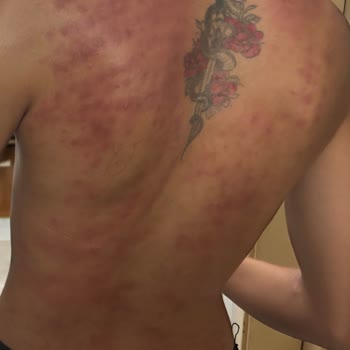 Lazer Epilasyon Sonrası Sırtımda Ciddi Yanık Oluştu