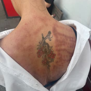 Lazer Epilasyon Sonrası Sırtımda Ciddi Yanık Oluştu