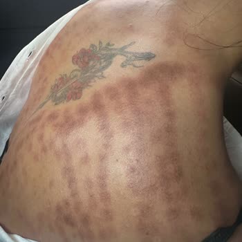 Lazer Epilasyon Sonrası Sırtımda Ciddi Yanık Oluştu