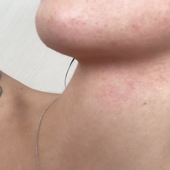 Watsons Micellar Yüz Temizleme Jeli Cildimde Alerjik Reaksiyona Sebep Oldu