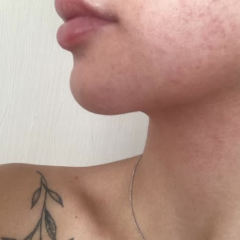 Watsons Micellar Yüz Temizleme Jeli Cildimde Alerjik Reaksiyona Sebep Oldu