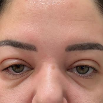 La Roche-Posay Anthelios Uvmune 400 SPF 50+ Sunscreen Caused Severe Allergic Reactions