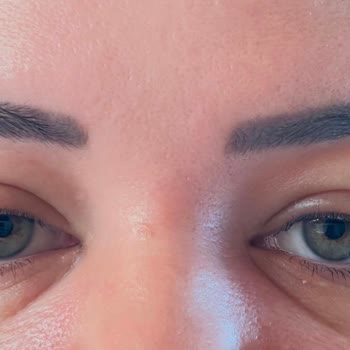 La Roche-Posay Anthelios Uvmune 400 SPF 50+ Sunscreen Caused Severe Allergic Reactions