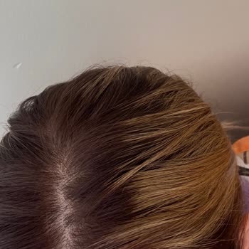 Saloon Oğuzhan Bosna Saçlarım İşlemden Zarar Gördü İstediğim Gibi Olmadı!