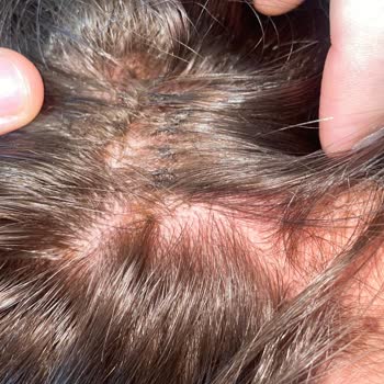 Saç Boyama Hizmetinde Ciddi Sağlık Sorunu Ve Yetersiz İlgi