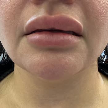 Dudak Dolgusu Sonrası Asimetri Ve Topaklanma, Ücret İadesi Talebim Var