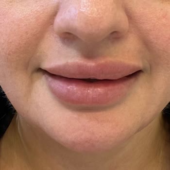 Dudak Dolgusu Sonrası Asimetri Ve Topaklanma, Ücret İadesi Talebim Var