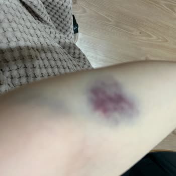 Acil Serviste Dikkatsiz Hemşire Nedeniyle Kan Alımında Yaşanan Mağduriyet