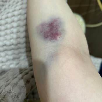 Acil Serviste Dikkatsiz Hemşire Nedeniyle Kan Alımında Yaşanan Mağduriyet