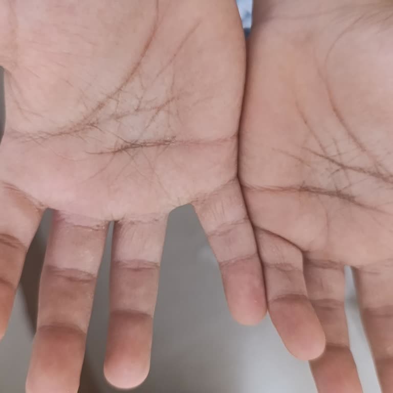 Activex Antibakteriyel Sıvı Sabun Cildimizde Tahrişe Ve Lekelenmeye Sebep Oldu