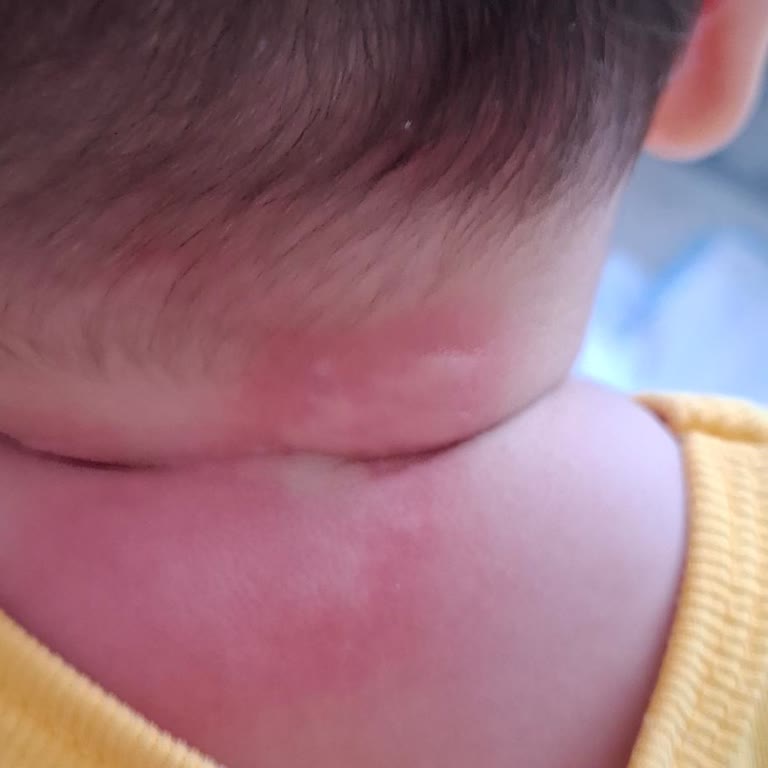 Aptamil 2 Mama Sonrası Bebeğimde Alerjik Reaksiyonlar Başladı