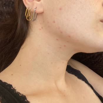 Garnier C Vitamina Crema Solar, erupciones e irritación facial tras uso