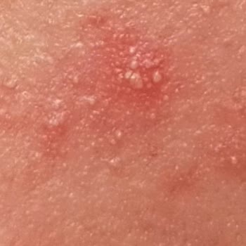 Garnier C Vitamina Gel Facial, reacción alérgica y daño en mi piel