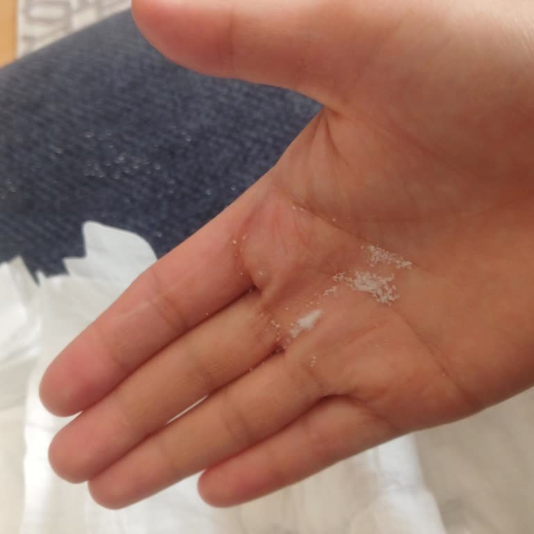 Molfix Bebek Bezlerinde Kristal Partikül Sorunu Ve Cilt Yaralanması