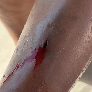 Otelin İhmali Sonucu Yaşanan Yaralanma Ve İlgisizlik