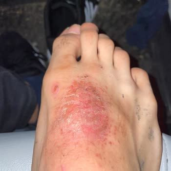 Skechers Ayakkabı Ayağımda Yara Oluşturdu, İade Talebim Reddedildi