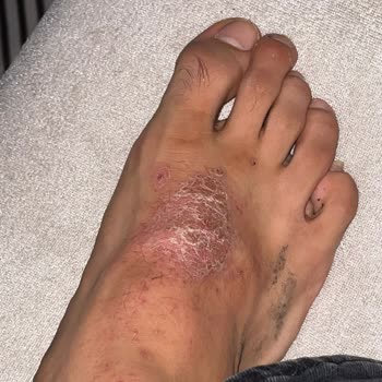 Skechers Ayakkabı Ayağımda Yara Oluşturdu, İade Talebim Reddedildi