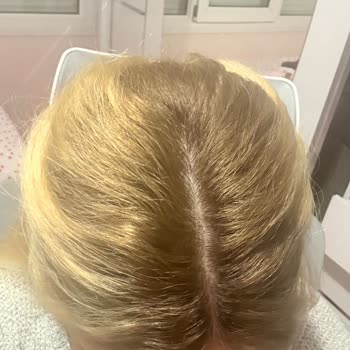 Saç Açma İşleminde Sağlık Ve Güvenlik İhmali, Profesyonellikten Uzak Hizmet