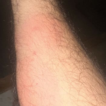 Otobüste Tahta Kurusu Ve Hijyen Sorunu Nedeniyle Sağlık Problemi Yaşadım