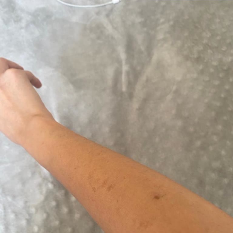 Medical Park Hastanesi Lazer Sonrası Kalıcı İz Ve Telafisiz Mağduriyet