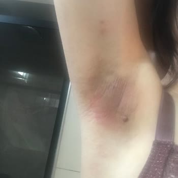 Yves Rocher Roll On Ürünü Cildimde Alerjiye Sebep Oldu, Ücret İadesi Talep Ediyorum