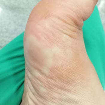 Polaris Sandalet Alerjiye Sebep Oldu, Sağlığım Bozuldu