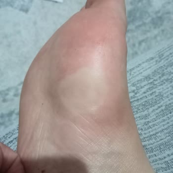 Polaris Sandalet Alerjiye Sebep Oldu, Sağlığım Bozuldu