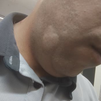 Deva İlaç Amoklavin Kullanımı Sonrası Yaşanan Kalp Ritim Bozukluğu Endişesi