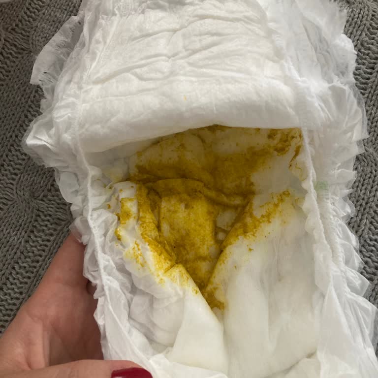 Bebekte Mama Sonrası İshal Ve Kusma Şikayeti