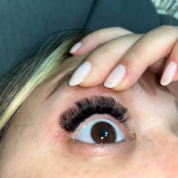 Güzellik Salonu İşleminden Sonra Yaşanan Sağlık Sorunları ve Mağduriyet