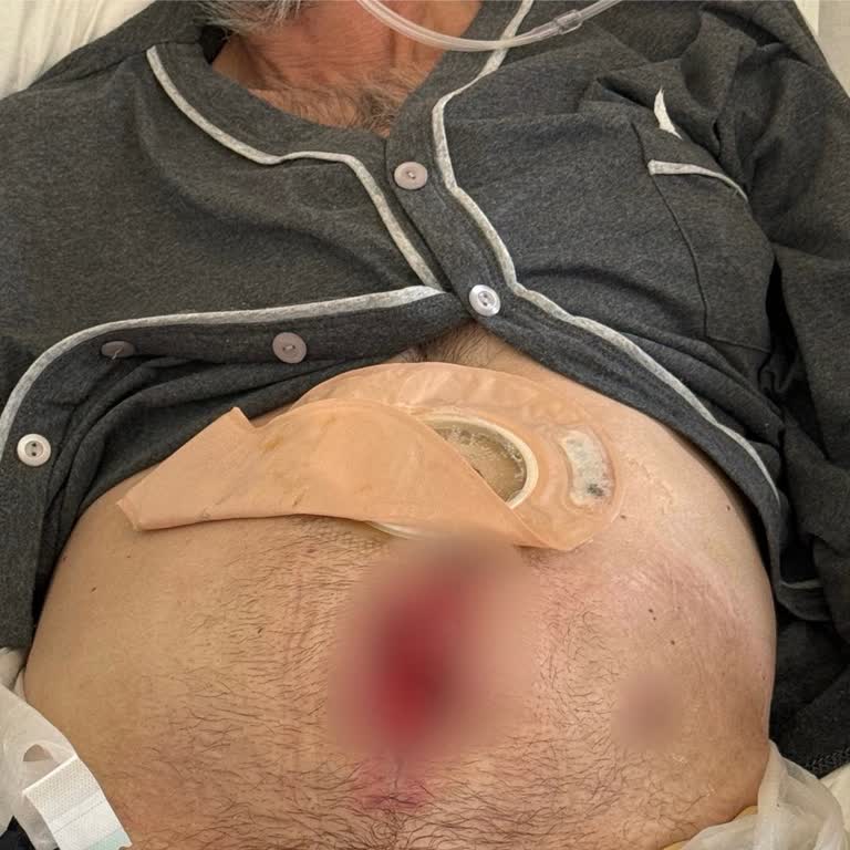 Kolonoskopi Sonrası Yaşanan Ciddi Sağlık Sorunları Ve İlgisizlik