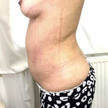 Liposuction Sonrası Beklenmeyen Sorunlar Ve Kalıcı Memnuniyetsizlik