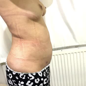 Liposuction Sonrası Beklenmeyen Sorunlar Ve Kalıcı Memnuniyetsizlik