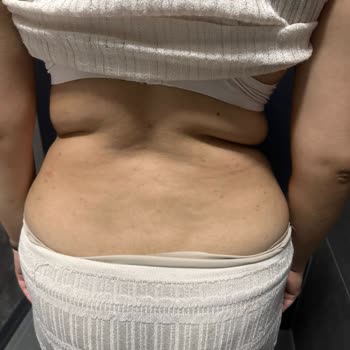 Liposuction Sonrası Beklenmeyen Sorunlar Ve Kalıcı Memnuniyetsizlik