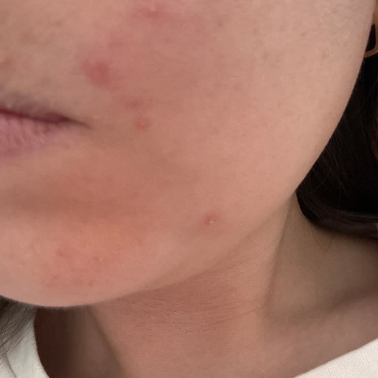 Sinoz Güneş Kremi Ciltte Alerji Ve Tahrişe Sebep Oldu