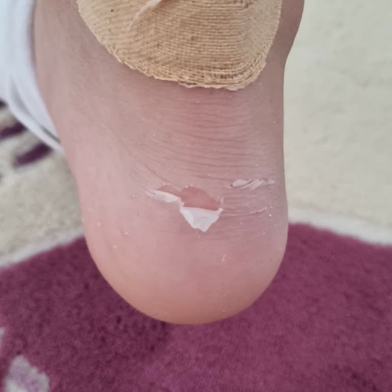 Yeni Alınan Ayakkabının Ayak Bileğinde Yaraya Sebep Olması Ve İade Talebi