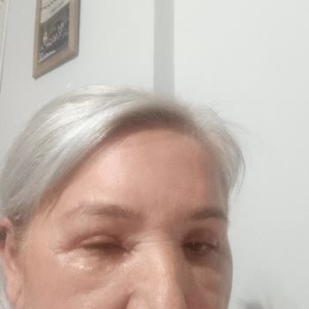 Saç Açıcı Sonrası Ciddi Sağlık Sorunları Ve Kalıcı Mağduriyet Yaşadım