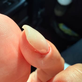 Protez Tırnak Sonrası Enfeksiyon Ve Kötü Uygulama Deneyimi