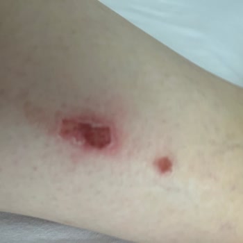 Kırık Kapaklı Temizlik Ürünü Halılarımızı Ve Eşimin Bacağını Yaktı Migros İlgisiz Kaldı